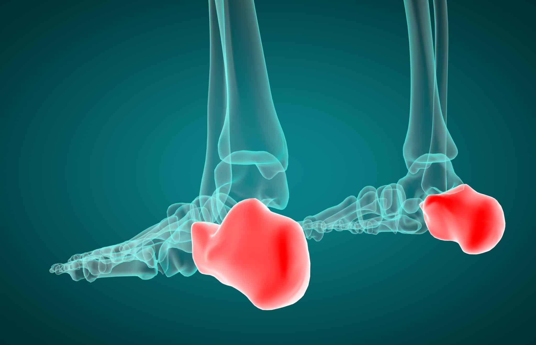 3D illustration of calcaneus xray