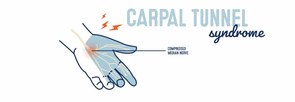 Carpal Tunnel Syndrome